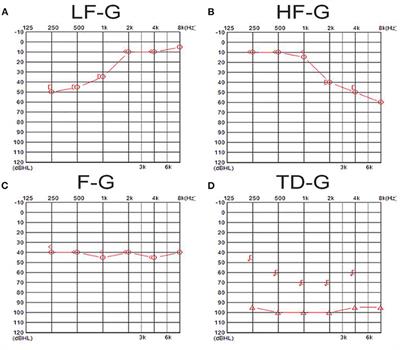 Visualization of Endolymphatic Hydrops in Patients With Unilateral Idiopathic Sudden Sensorineural Hearing Loss With Four Types According to Chinese Criterion
